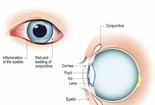治疗红眼病的3大中药方有哪些