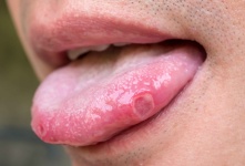 舌头尖有裂痕怎么办 舌头尖有裂痕的改善方法分享