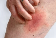 大腿内侧皮肤瘙痒红疹怎么缓解