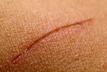疤痕体质疙瘩怎么治疗 什么是疤痕体质