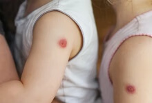 湿疹症状特征有哪些 三大症状不可忽视