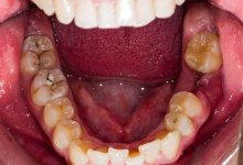 牙龈炎会导致口腔炎么 牙龈炎会导致五个