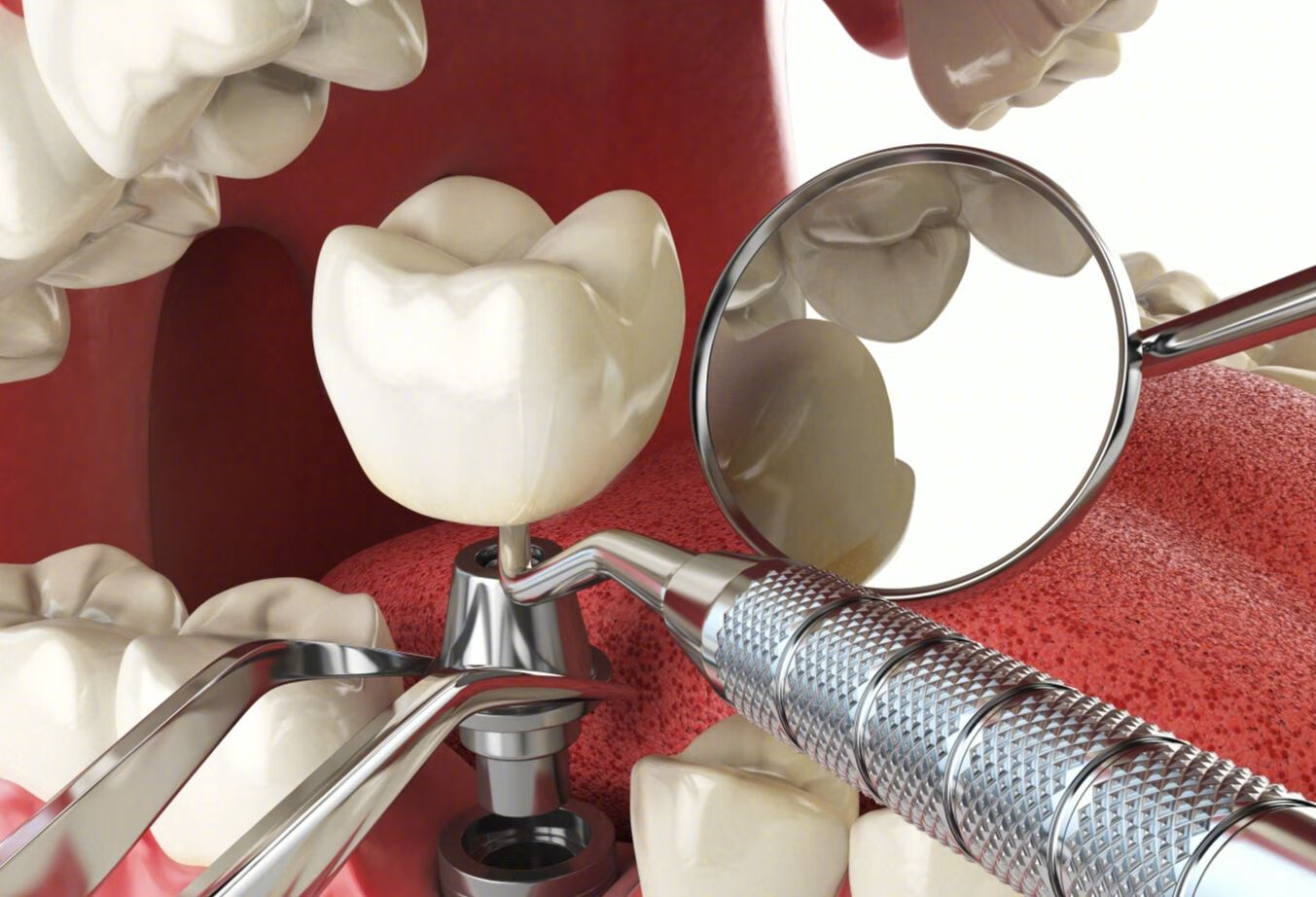 为什么医生镶一颗牙要磨掉两边的牙齿？