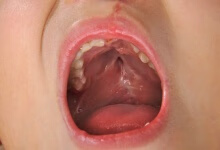 嘴巴上颚痛的治疗方法有哪些