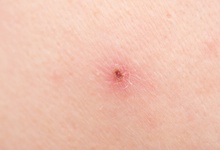 荨麻疹症状图片展示 从图片认识不同类型的荨麻疹