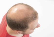 斑秃治疗最快的方法 推荐4个治疗斑秃的方法