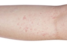 皮肤长湿疹擦什么药膏 四款药膏对湿疹有作用
