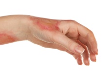 如何去掉烫伤的疤痕 掌握四招有效去掉烫伤的疤痕