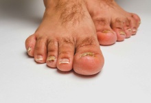 脚上灰指甲怎么治疗 三招助你治疗脚灰指甲