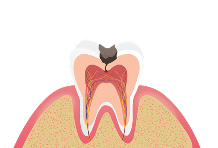 龋齿形成的原因有哪些 什么原因会导致龋齿出现