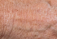 皮肤易长湿疹是导致的遗传吗   什么体质易长湿疹