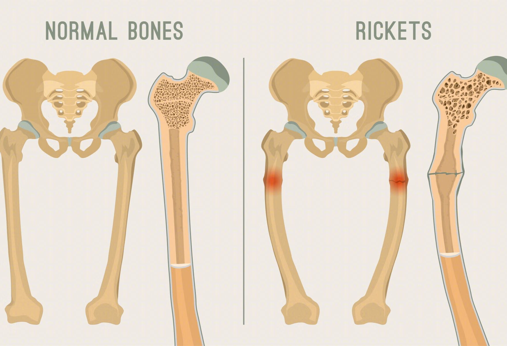 股骨头坏死保髋手术是微创or开放手术好？