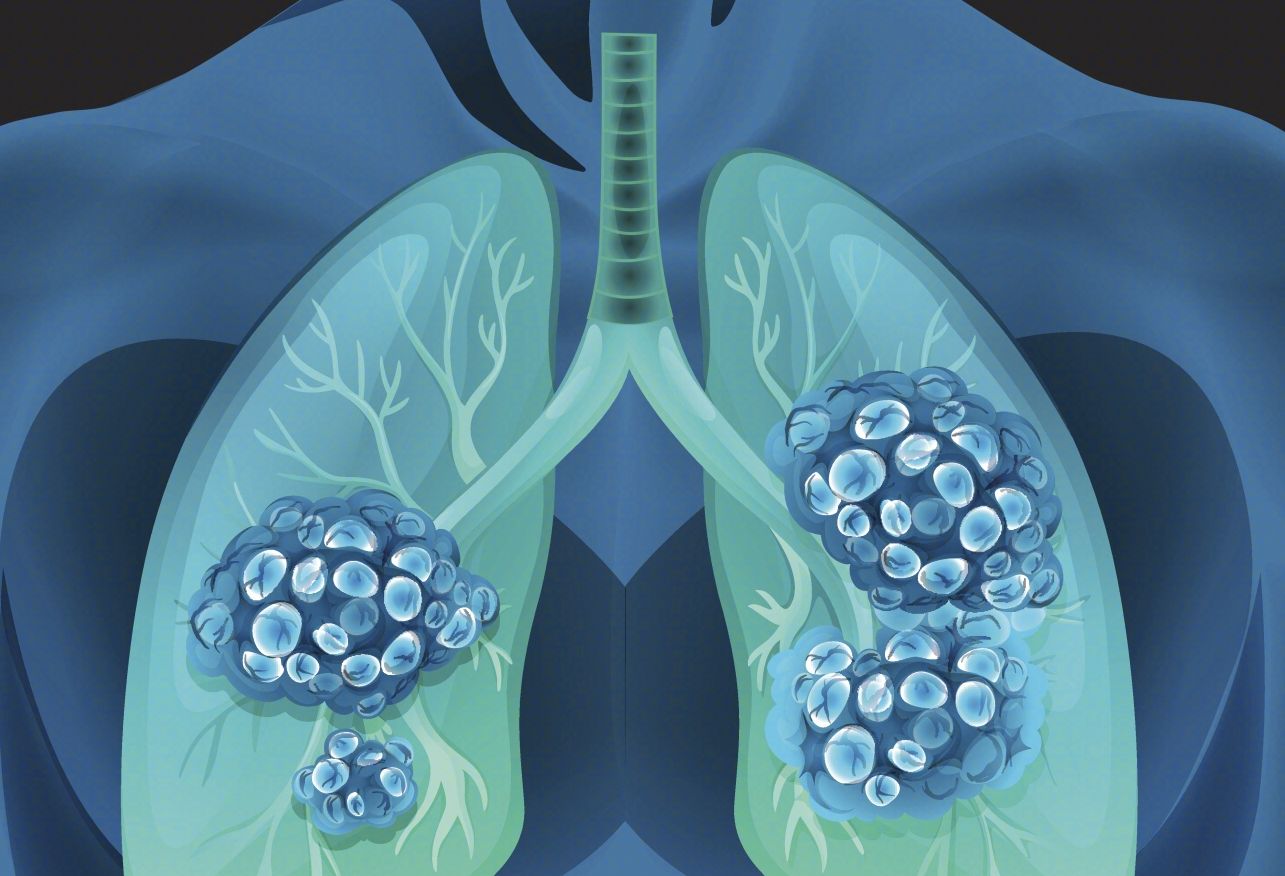 肺部疾病及肺癌家族史都是潜在的肺癌隐患