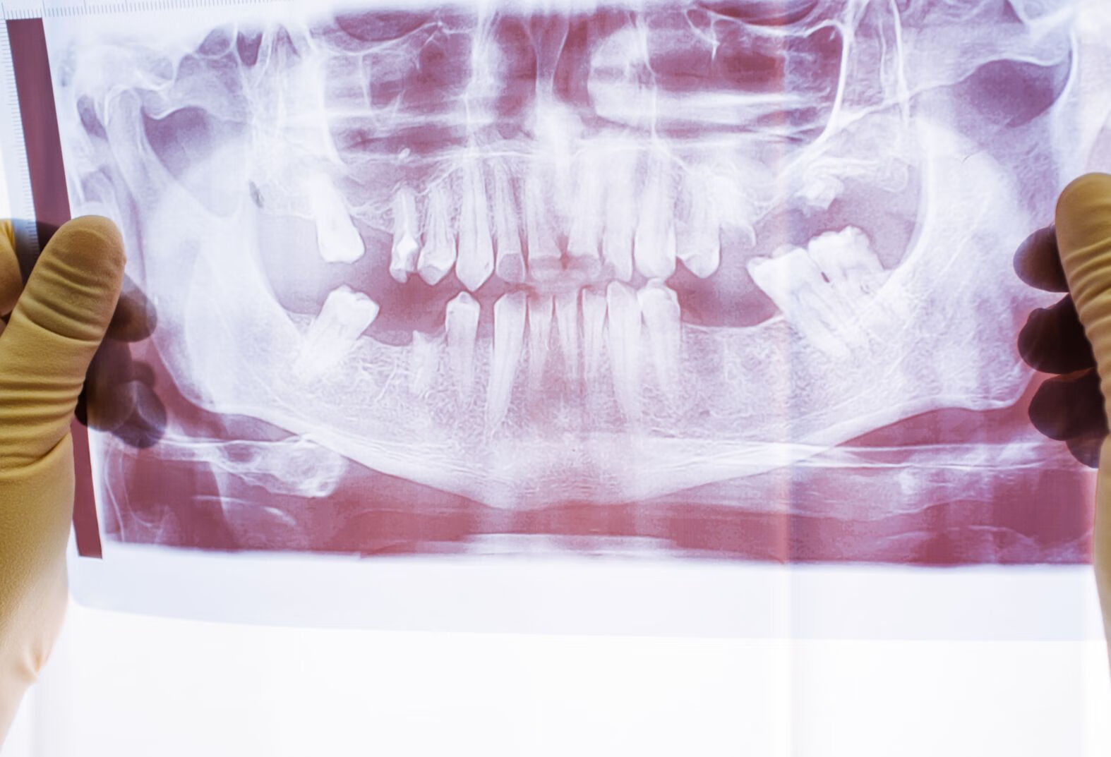 一咬牙牙疼是什么原因？