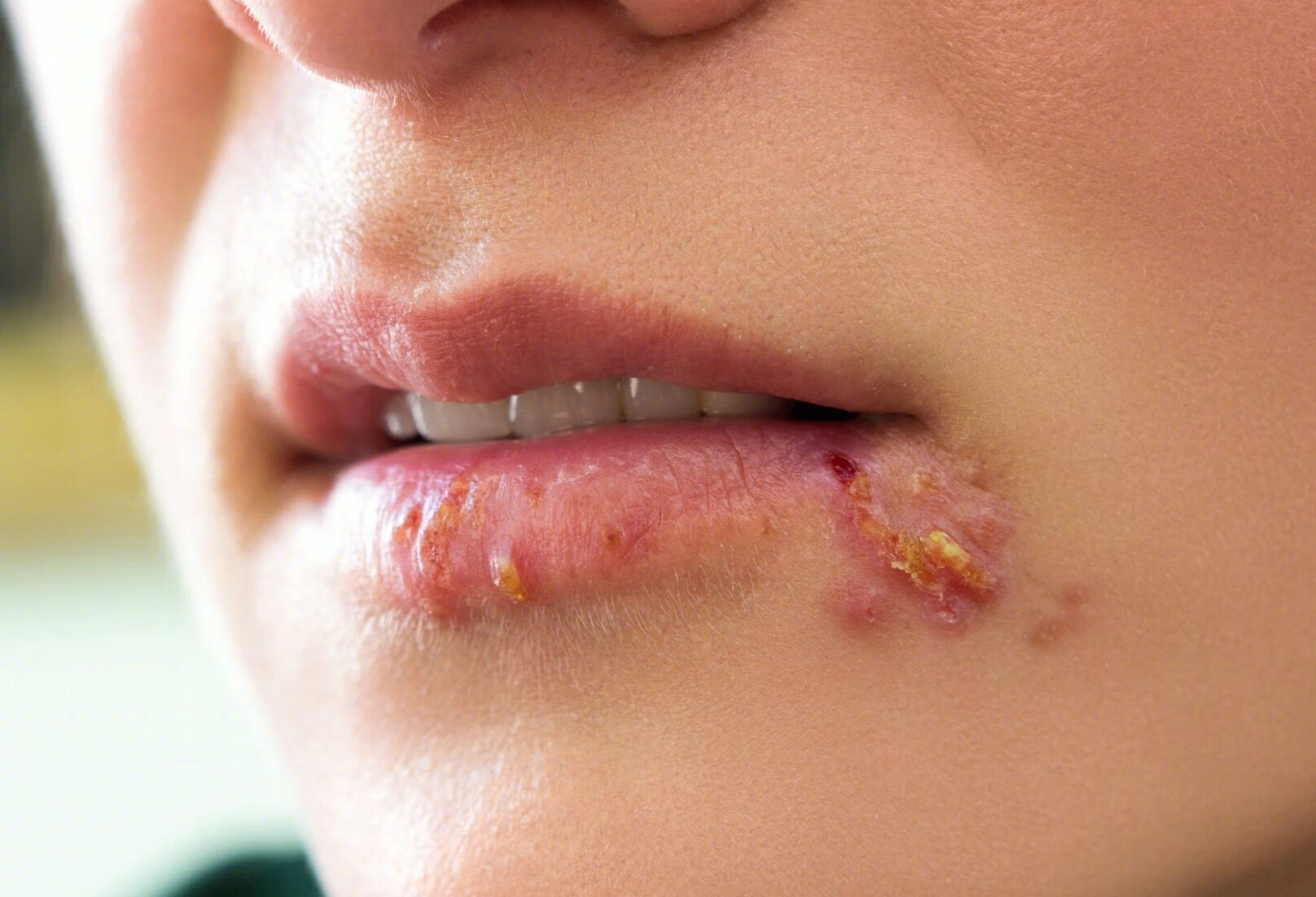 光化性唇炎如何治疗？