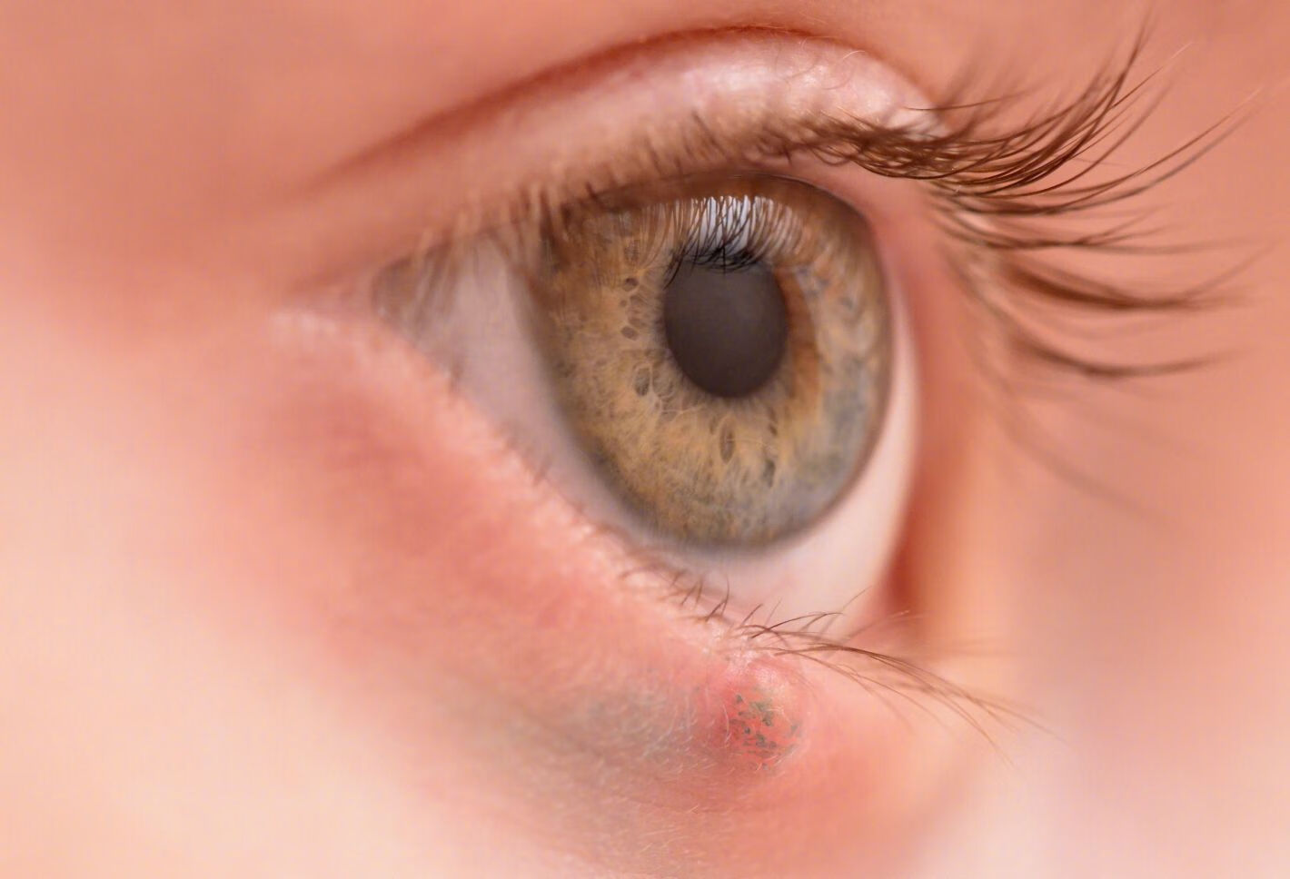 下眼睑内长小黄点该怎么治疗？