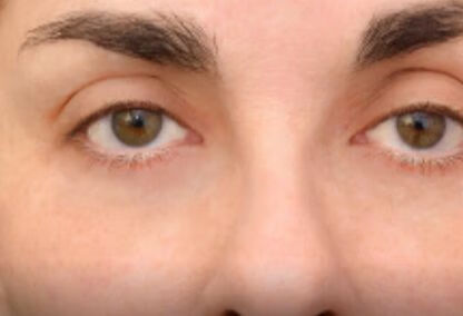 瞳神紧小病是什么病？