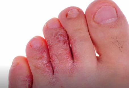 湿性脚气病用什么药物？
