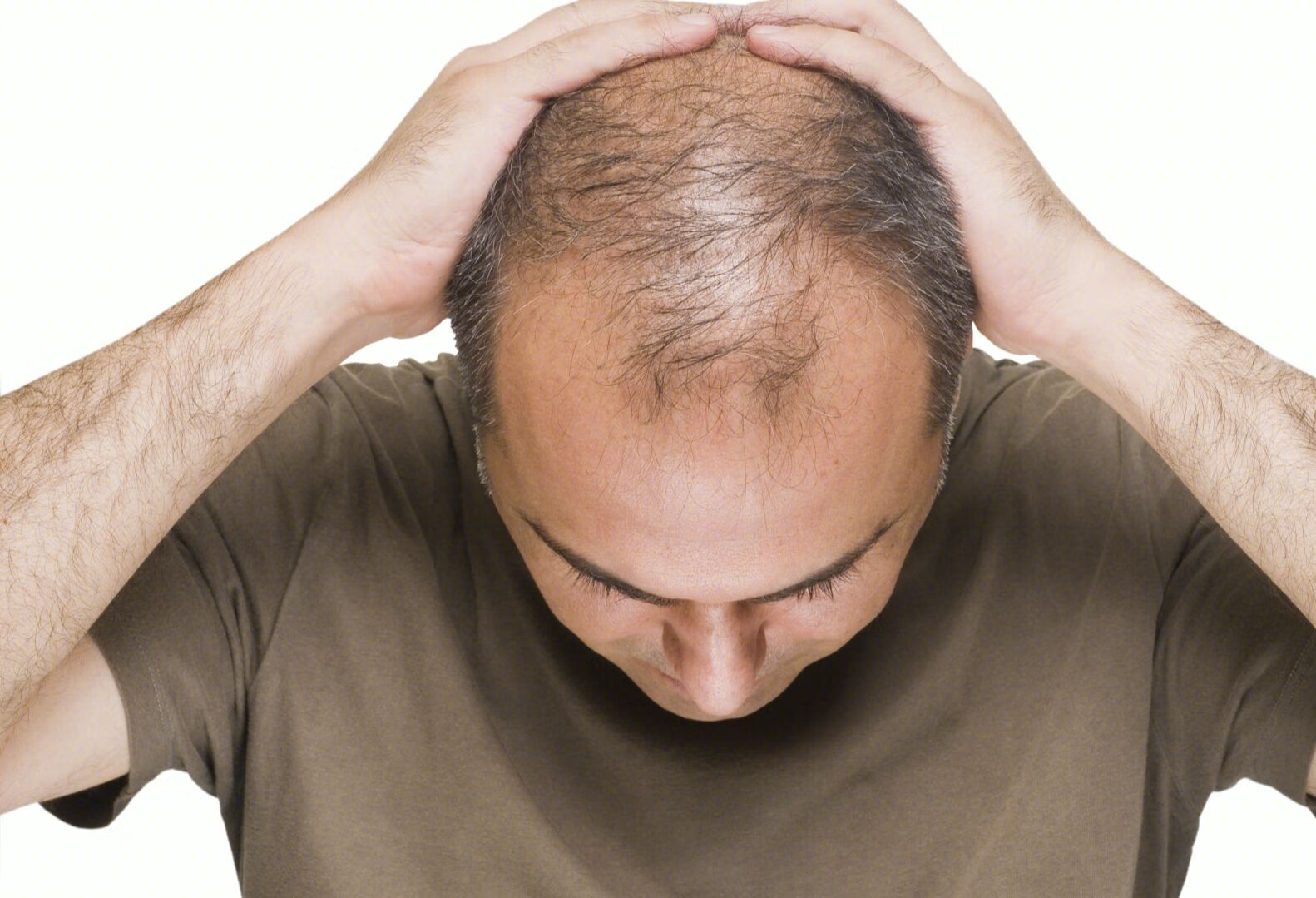 秃发性毛囊炎要涂什么药？