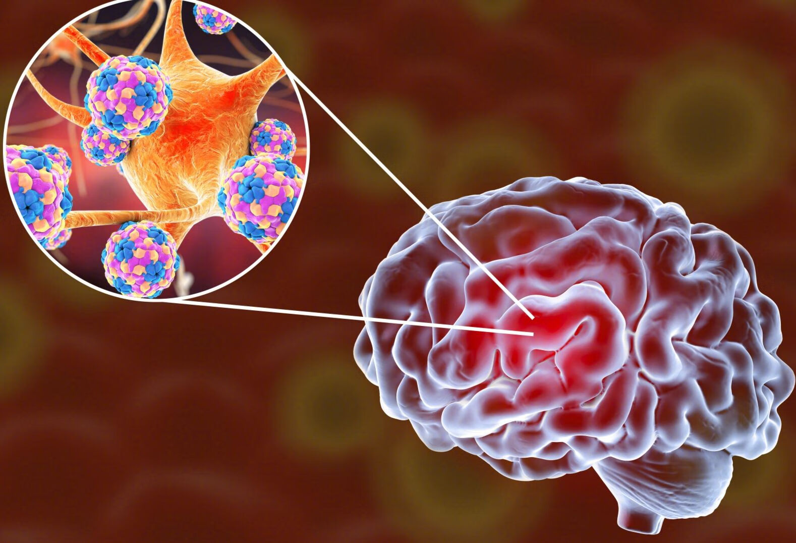 脑脊膜炎和脑炎的区别有哪些？