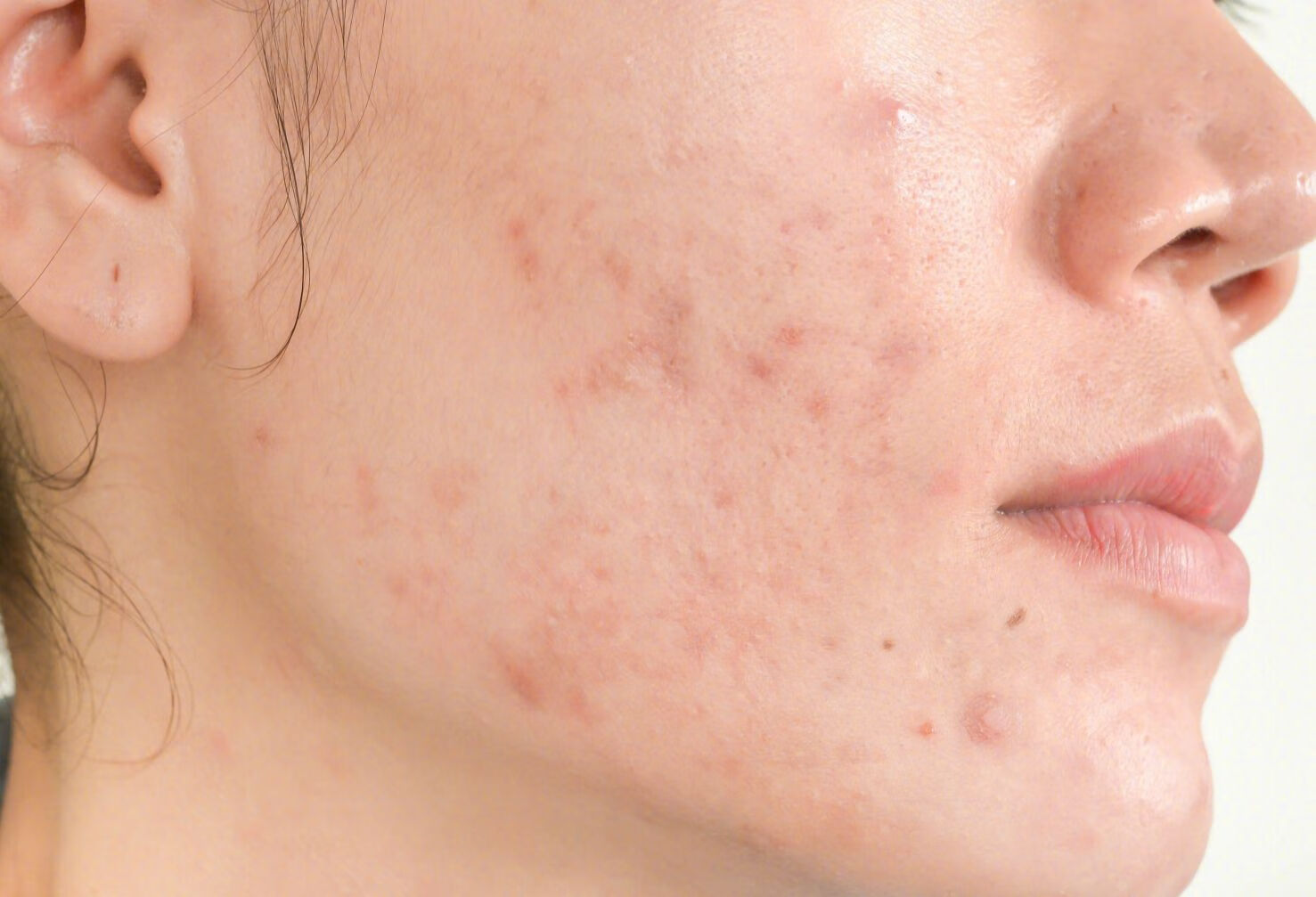 脸颊两侧长粉刺的护理方法有哪些？
