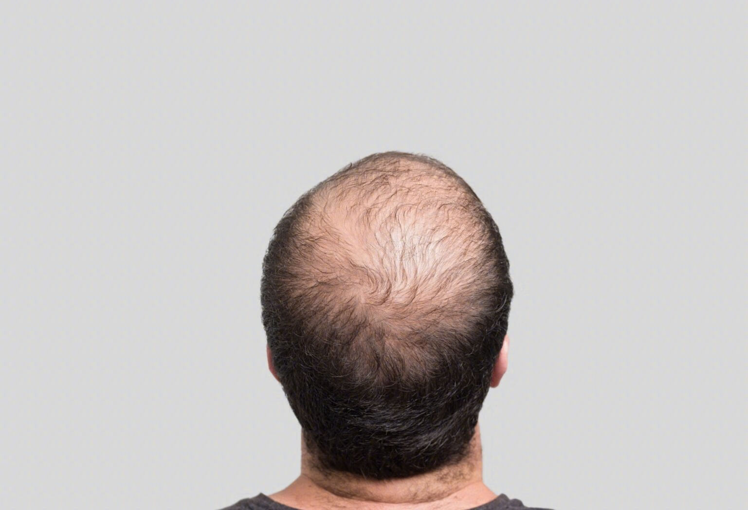 雄激素源性脱发和斑秃有什么区别？