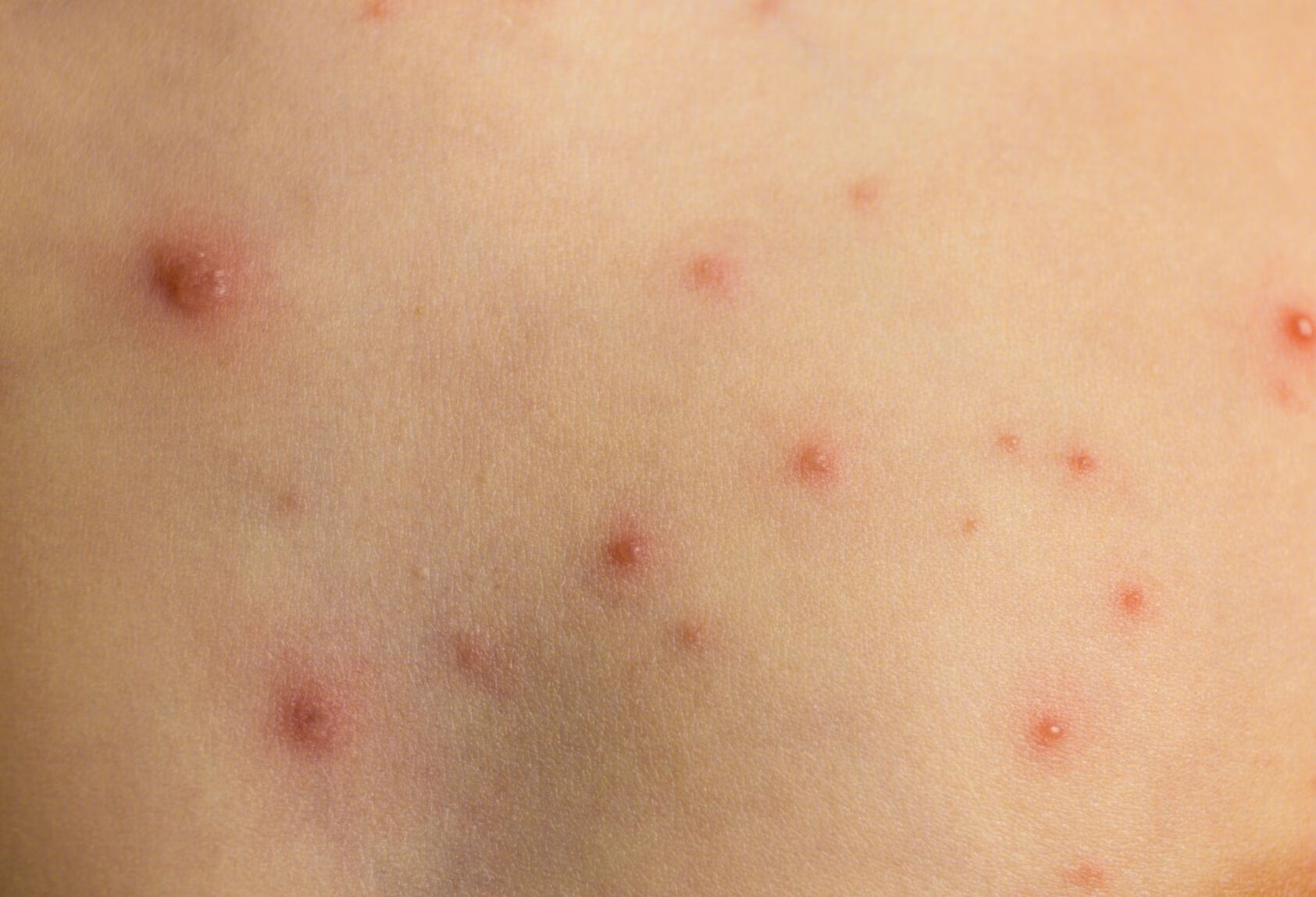 过敏性皮炎与疱疹的区别？