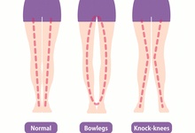 o型腿和佝偻病有关系吗 o型腿与两种疾病有关