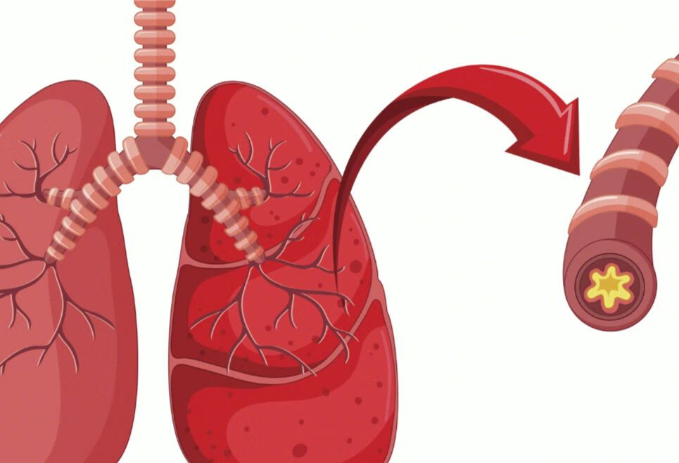 慢阻肺有胸痛的现象吗 ？