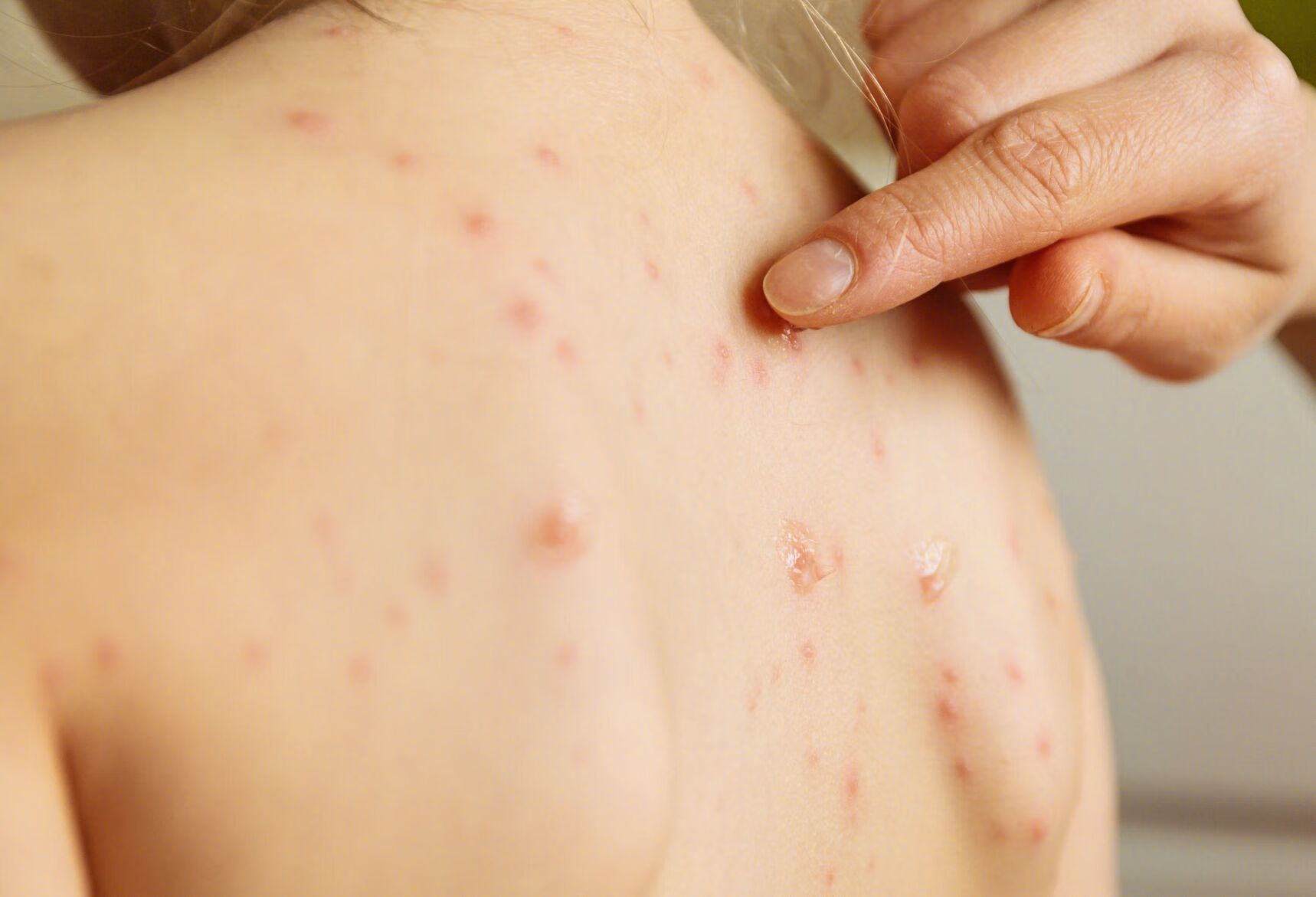 春季如何预防小孩皮肤过敏？