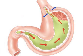 急性胃扩张的三大成因