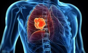 如何发现早期肺癌？6种症状要留意