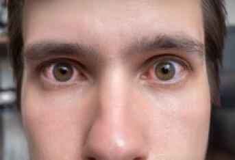 眼睛营养不良有什么症状 眼睛营养不良有3个症状