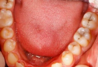 急性牙髓炎会一直疼下去吗 急性牙髓炎的具体症状分析