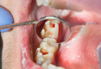 牙齿修复都有哪些方法呢？（二）