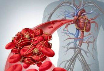 静脉血栓是怎么回事，该如何预防？