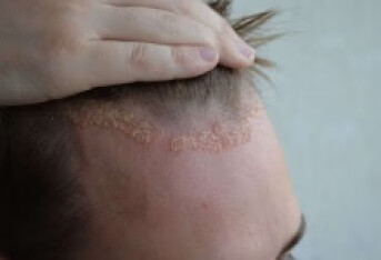 头皮裂伤会有后遗症吗 盘点头皮裂伤的常见后遗症