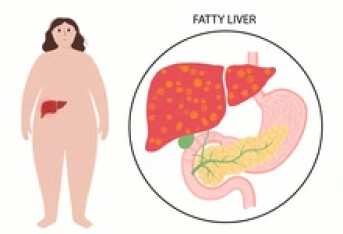 吸烟也会导致脂肪肝 脂肪肝病患病的原因分析