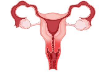 具春花：子宫内膜异位症的中西医疗法