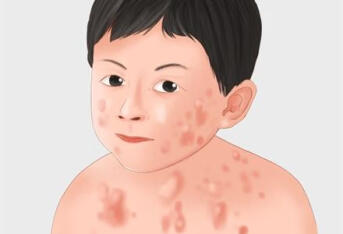 春季警惕感染引起皮肤病