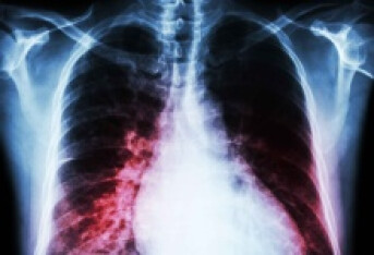 肺栓塞的并发症有哪些 肺栓塞的4个并发症要重视