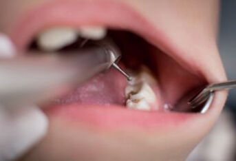 牙龈萎缩真的是不治之症吗？