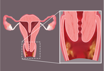 阴道有异味跟哪些妇科病有关？