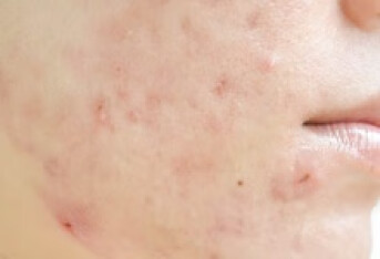正常皮肤中也有痤疮杆菌为何不患痤疮