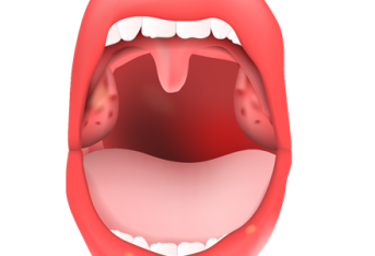 口腔扁平苔癣致嘴皮破？