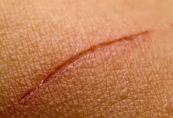 怎么修复疤痕呢   修复疤痕常见三种方法