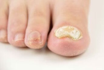 复方土槿皮酊治疗灰指甲效果如何