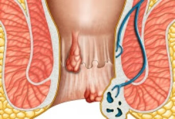 肛周脓肿复发的症状有什么 有三个征兆说明肛周脓肿复发
