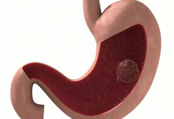 胃癌多是“养”起来的，胃不好的人，3个习惯尽早改掉