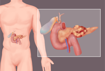 胰腺癌有4个典型症状，“癌王”凶险，如何避免？